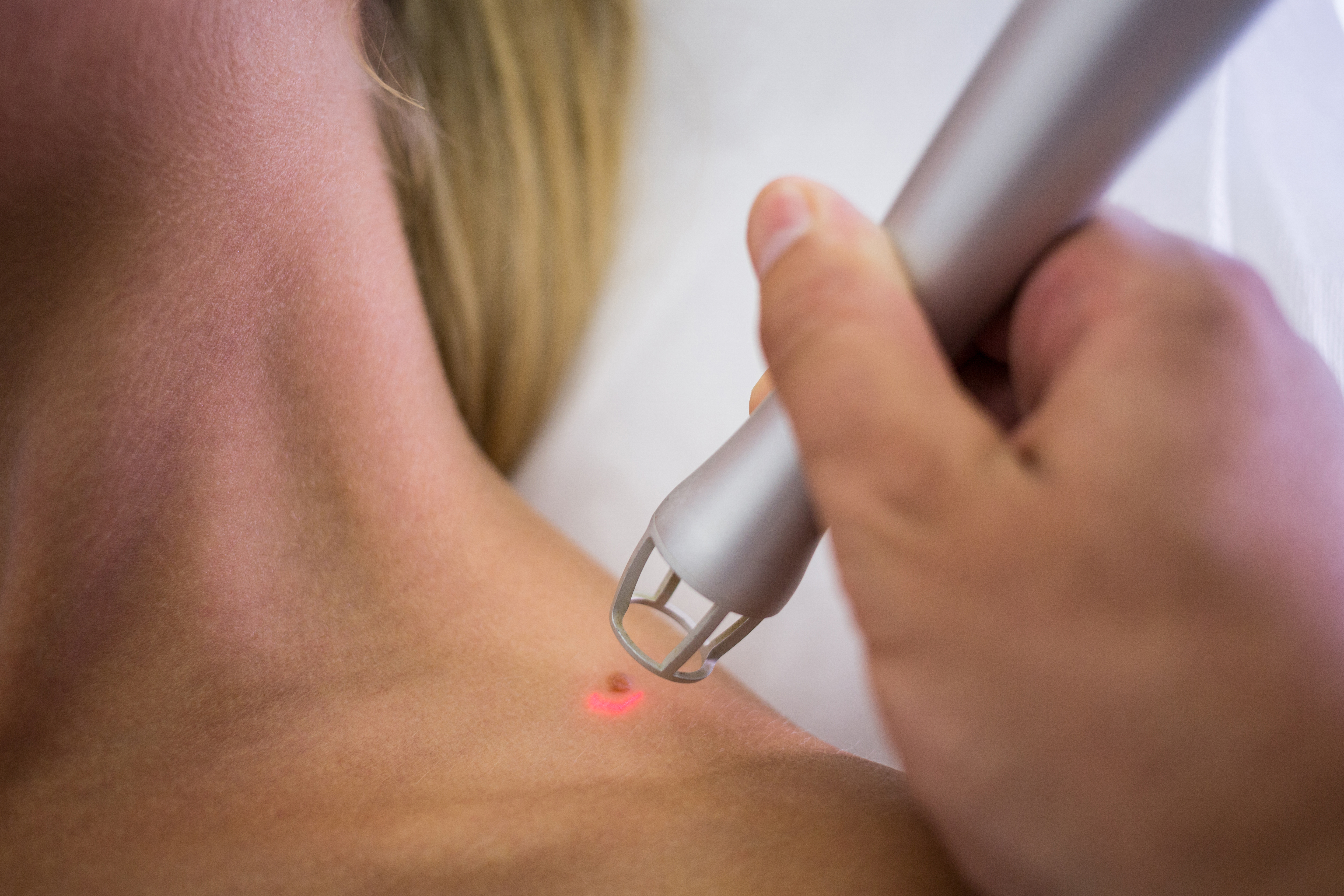 Warts and Mole Removal Image 2